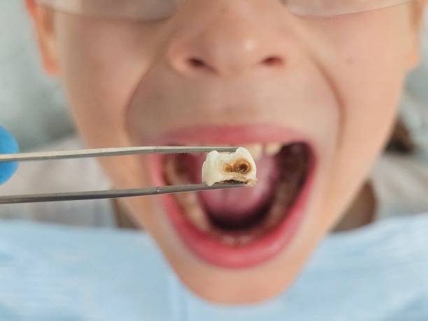 Best Emergency Treatment for Dental Infections or Abscesses in Fort Shawnee, OH