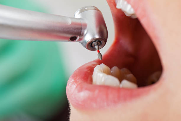 Best Emergency Tooth Extraction in Fort Shawnee, OH
